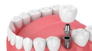 Diagram of a single tooth dental implant in Buzzards Bay