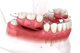 Illustration of partial dentures for lower dental arch