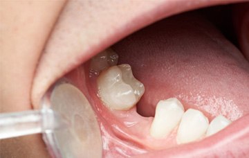 Dental bridge on a clay model